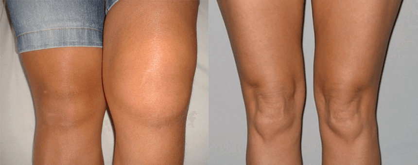 Erleben Sie die Verwendung von Cannabisöl-Kapseln vor und nach der Verwendung von Eva