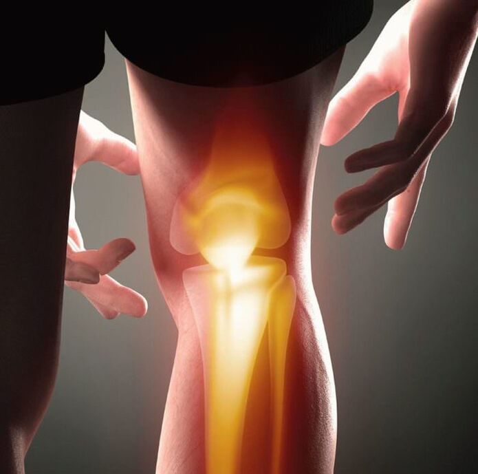 Was ist Arthritis und Arthrose